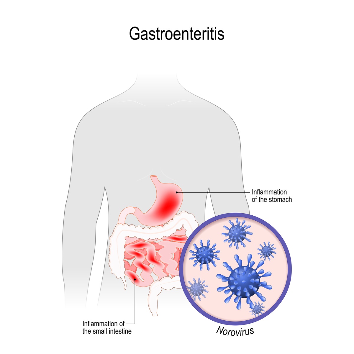 Norovírus ako príčina gastroenteritídy - zápal žalúdka a črevného traktu
